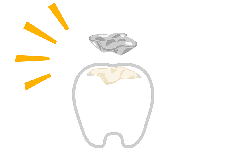 詰め物が取れる、割れる